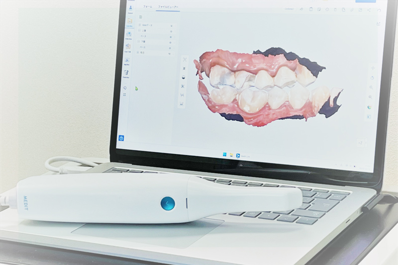 口腔内スキャナー(IOS)