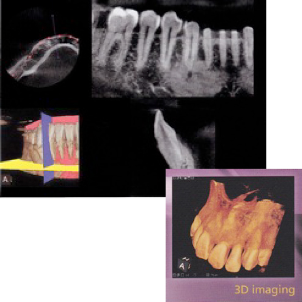 ＣＴ診断・最新の歯科用３Ｄ